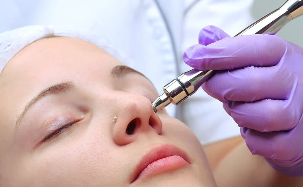 Microdermabrasion in Oakville